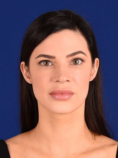 Female Rhinoplasty Before & After Gallery - Patient 17363737 - Image 2