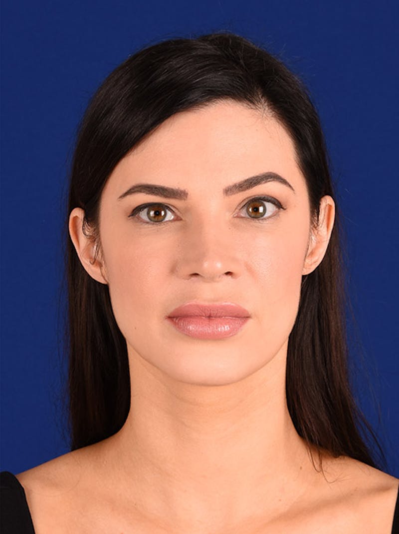 Female Rhinoplasty Before & After Gallery - Patient 17363737 - Image 2
