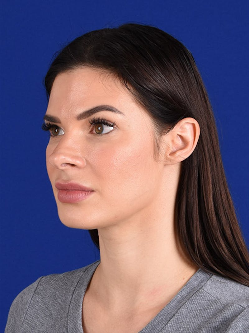 Female Rhinoplasty Before & After Gallery - Patient 17363737 - Image 3