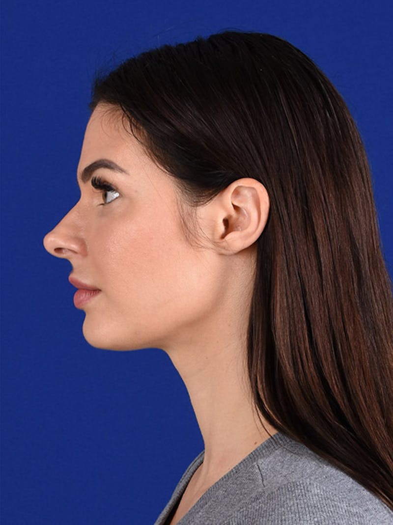 Female Rhinoplasty Before & After Gallery - Patient 17363737 - Image 5