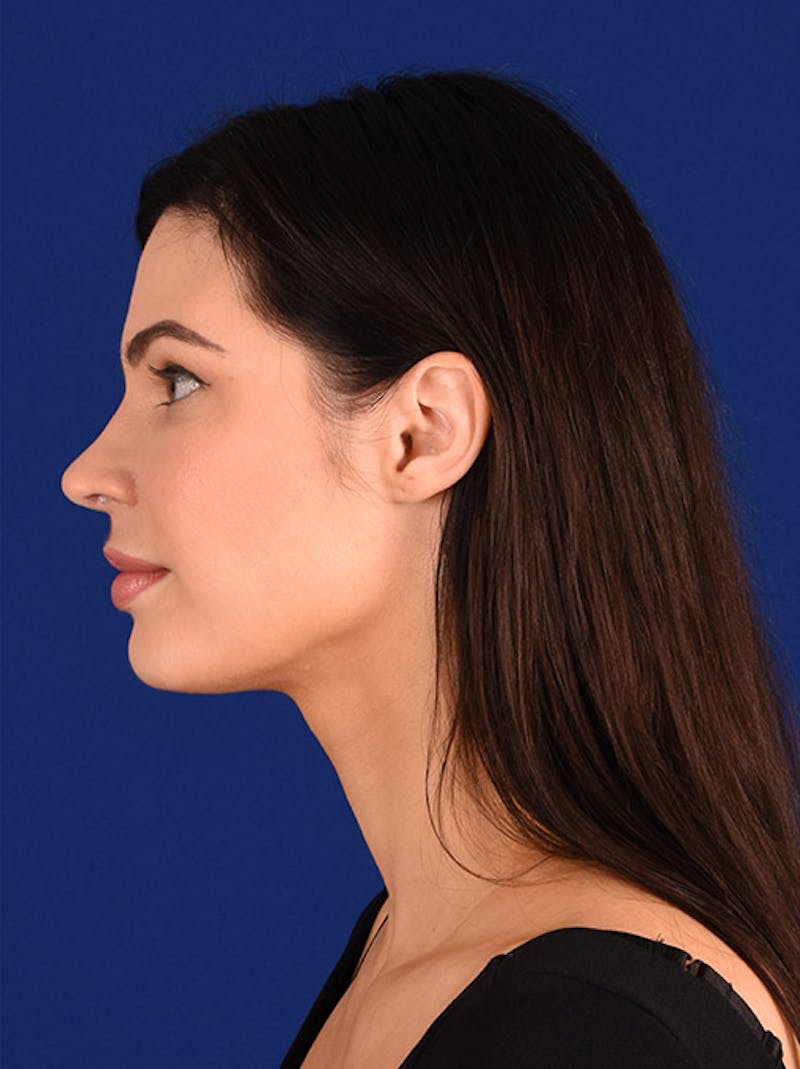 Female Rhinoplasty Before & After Gallery - Patient 17363737 - Image 6