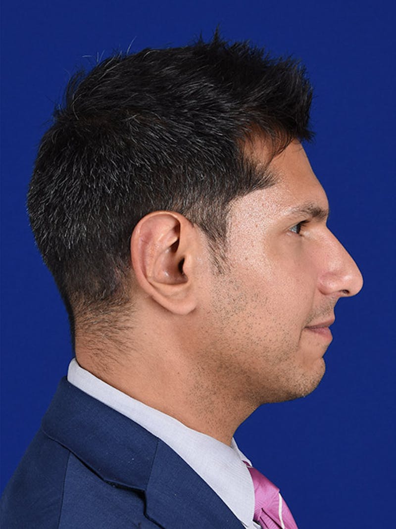 Rhinoplasty Before & After Gallery - Patient 18264947 - Image 5