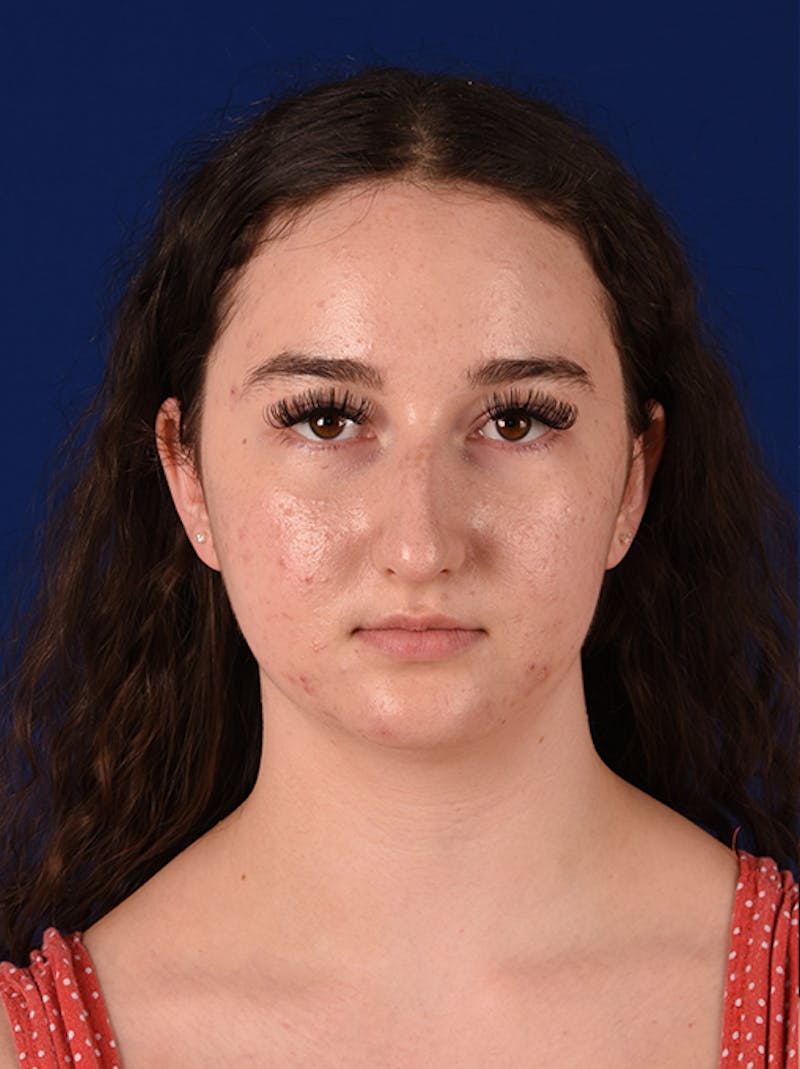 Female Rhinoplasty Before & After Gallery - Patient 17363740 - Image 1