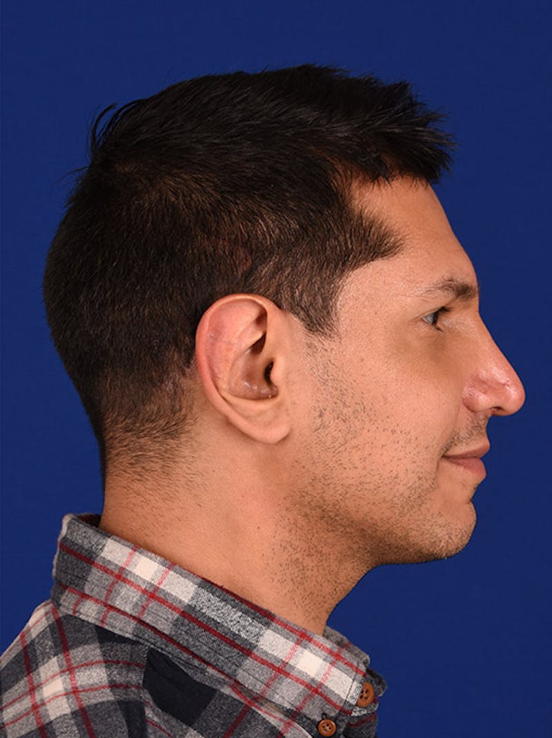 Male Rhinoplasty Before & After Gallery - Patient 17363738 - Image 6