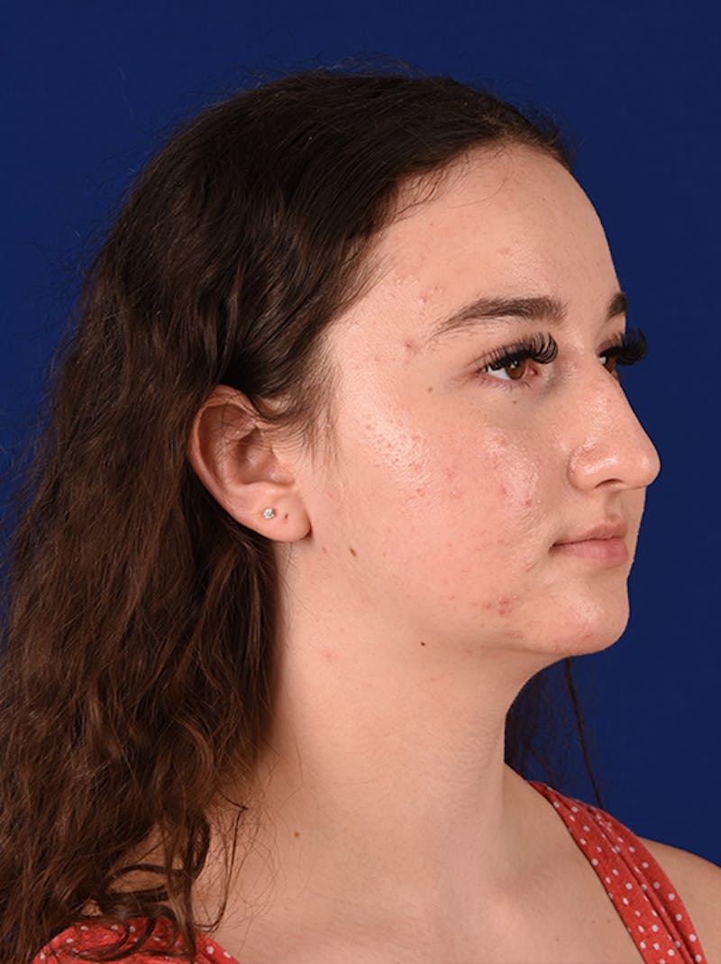 Female Rhinoplasty Before & After Gallery - Patient 17363740 - Image 3