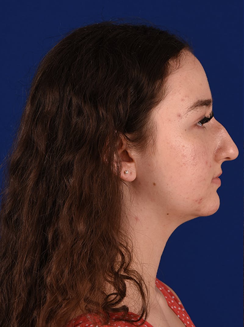 Female Rhinoplasty Before & After Gallery - Patient 17363740 - Image 5