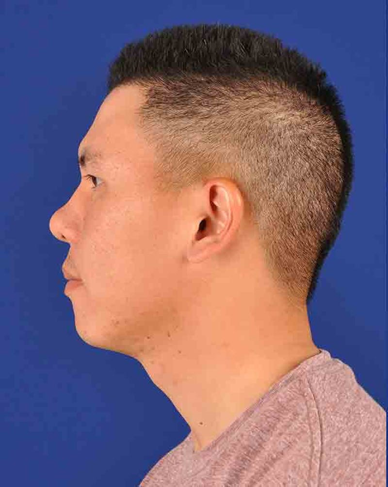 Rhinoplasty Before & After Gallery - Patient 18264948 - Image 5
