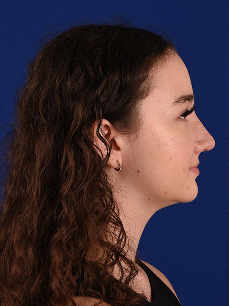Female Rhinoplasty Before & After Gallery - Patient 17363740 - Image 6