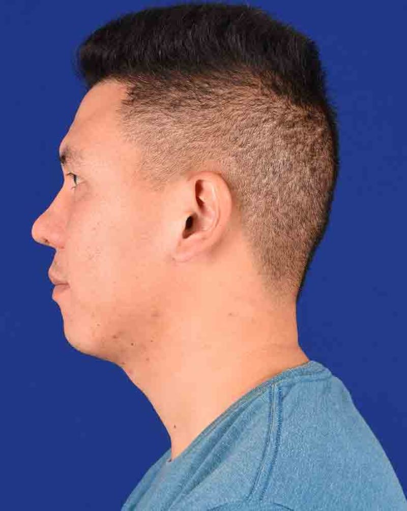 Male Rhinoplasty Before & After Gallery - Patient 17363739 - Image 6