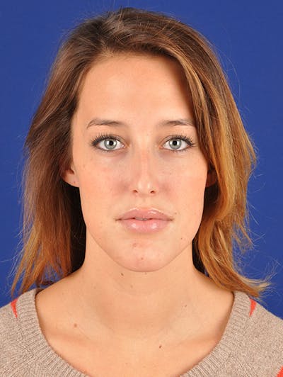 Female Rhinoplasty Before & After Gallery - Patient 17363742 - Image 1