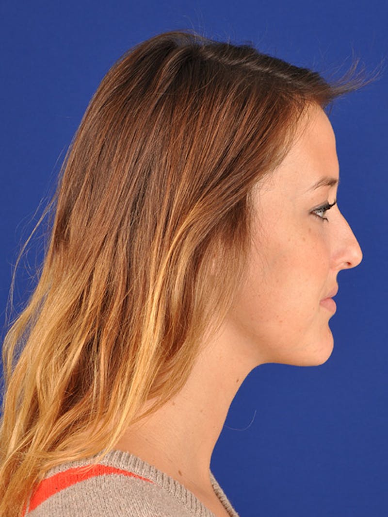 Female Rhinoplasty Before & After Gallery - Patient 17363742 - Image 5