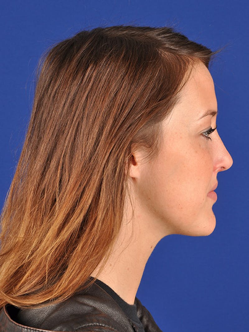 Female Rhinoplasty Before & After Gallery - Patient 17363742 - Image 6