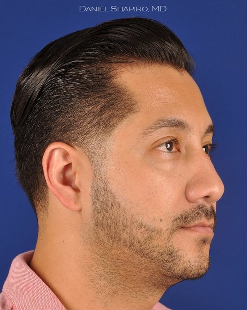 Male Rhinoplasty Before & After Gallery - Patient 17363743 - Image 3