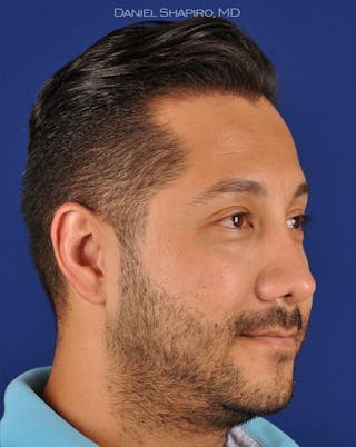 Rhinoplasty Before & After Gallery - Patient 18264950 - Image 4