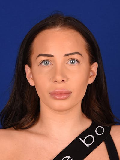 Female Rhinoplasty Before & After Gallery - Patient 17363744 - Image 2