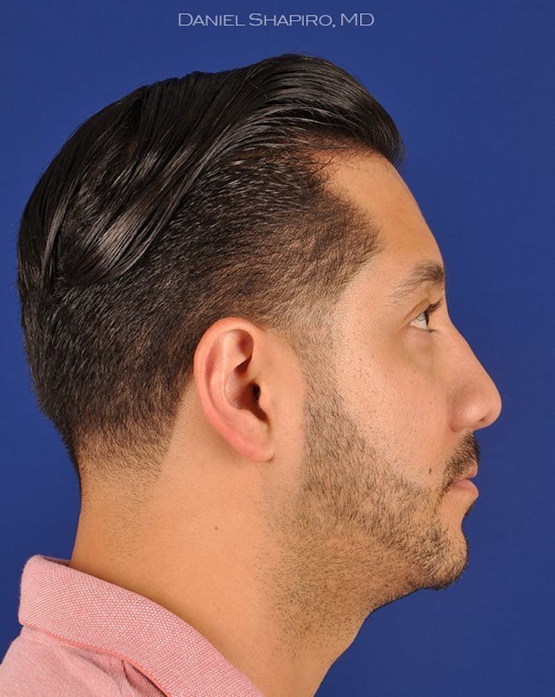 Male Rhinoplasty Before & After Gallery - Patient 17363743 - Image 5