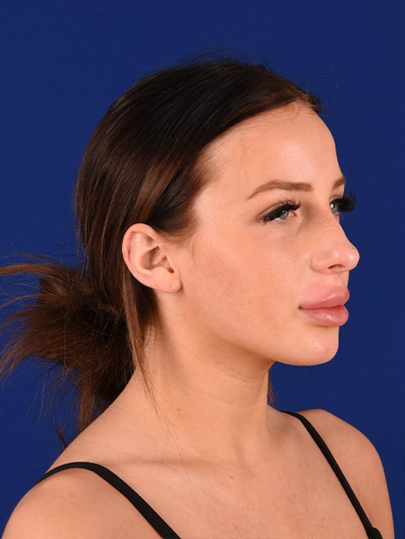 Female Rhinoplasty Before & After Gallery - Patient 17363744 - Image 3