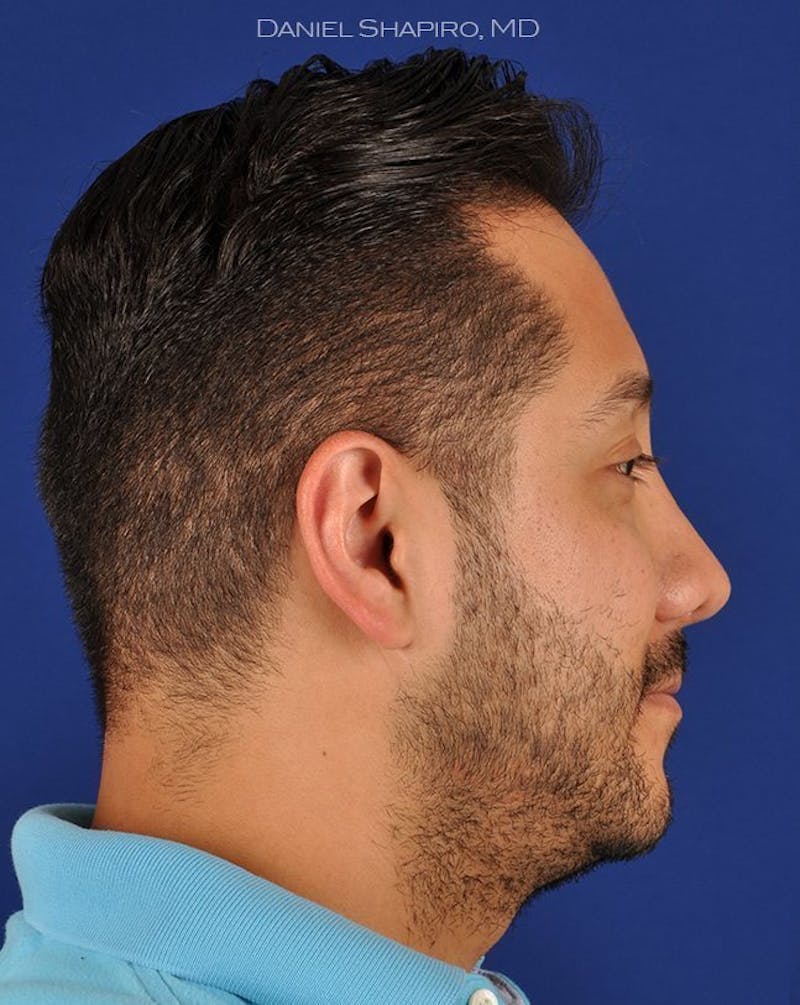 Male Rhinoplasty Before & After Gallery - Patient 17363743 - Image 6