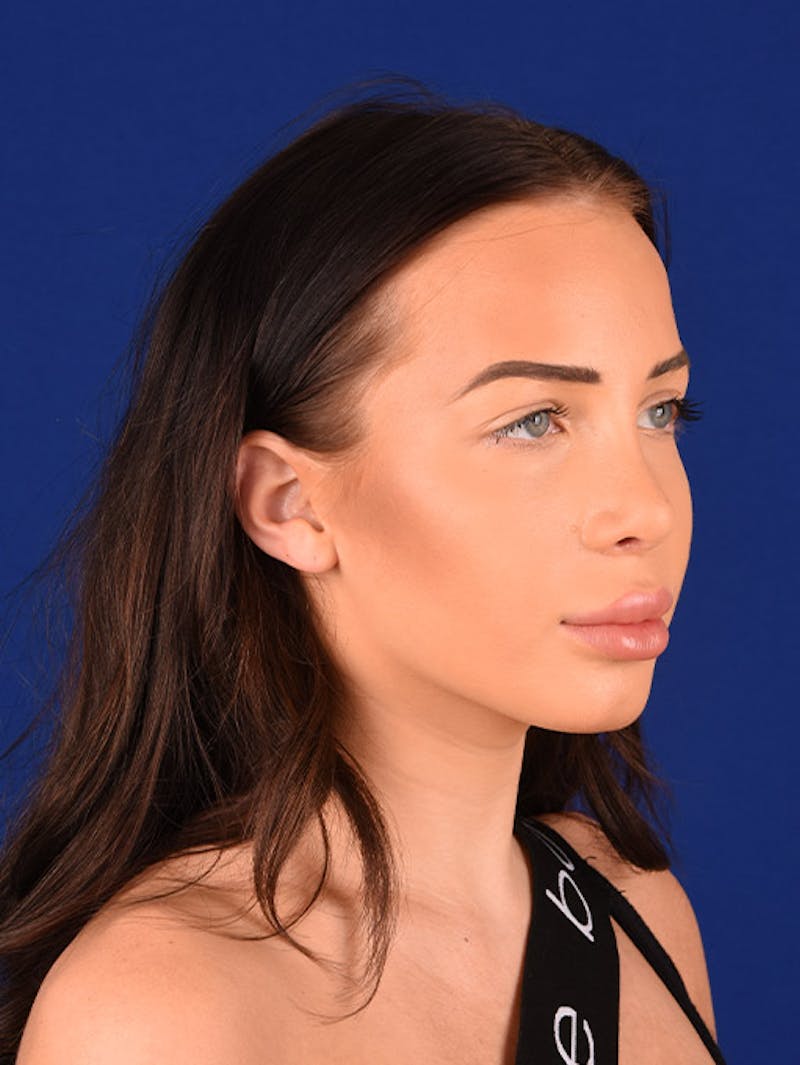 Female Rhinoplasty Before & After Gallery - Patient 17363744 - Image 4