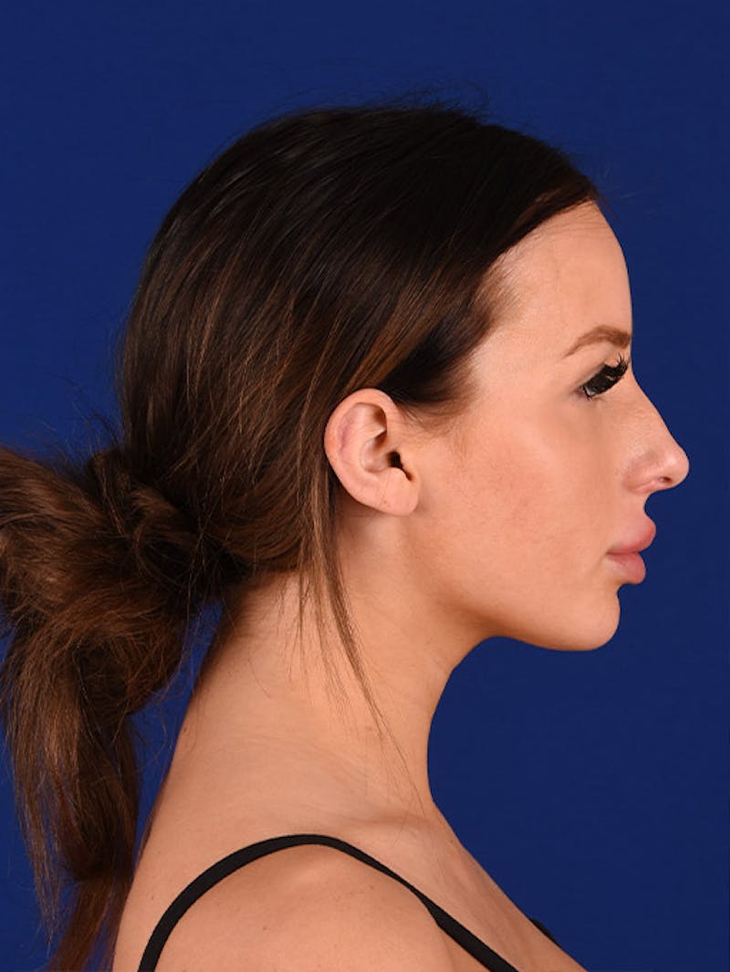 Female Rhinoplasty Before & After Gallery - Patient 17363744 - Image 5