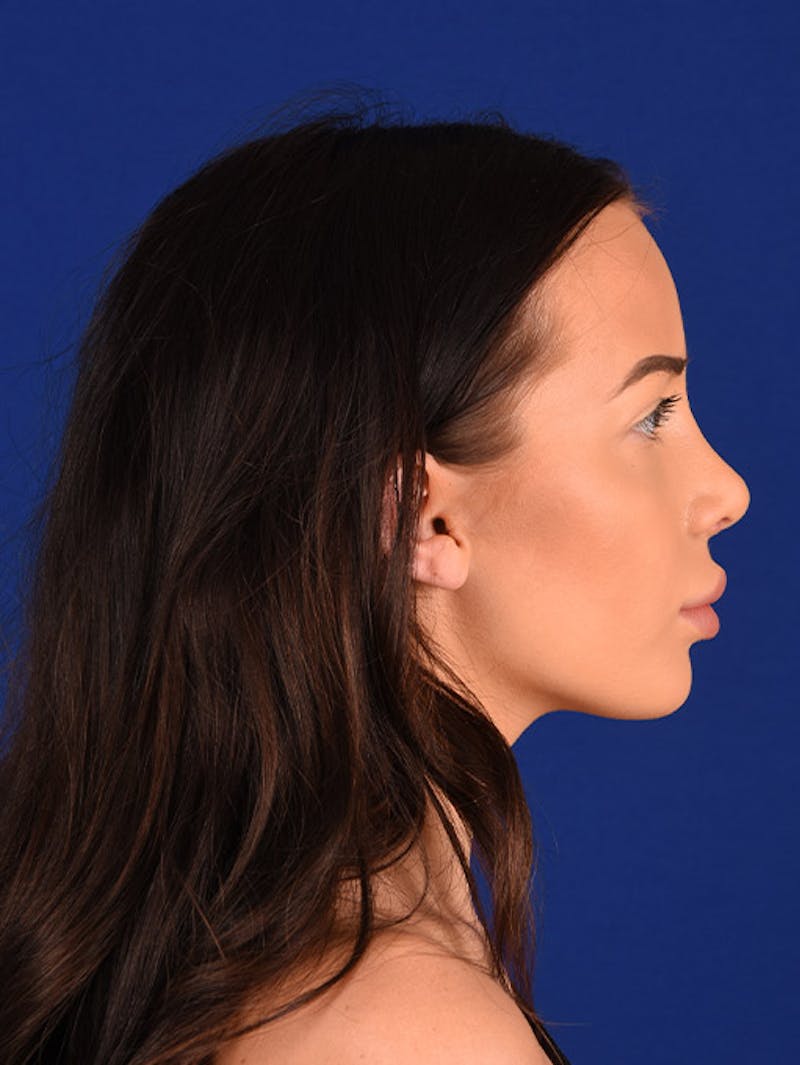 Female Rhinoplasty Before & After Gallery - Patient 17363744 - Image 6