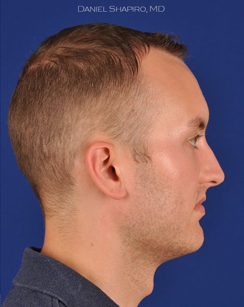 Male Rhinoplasty Before & After Gallery - Patient 17363745 - Image 5