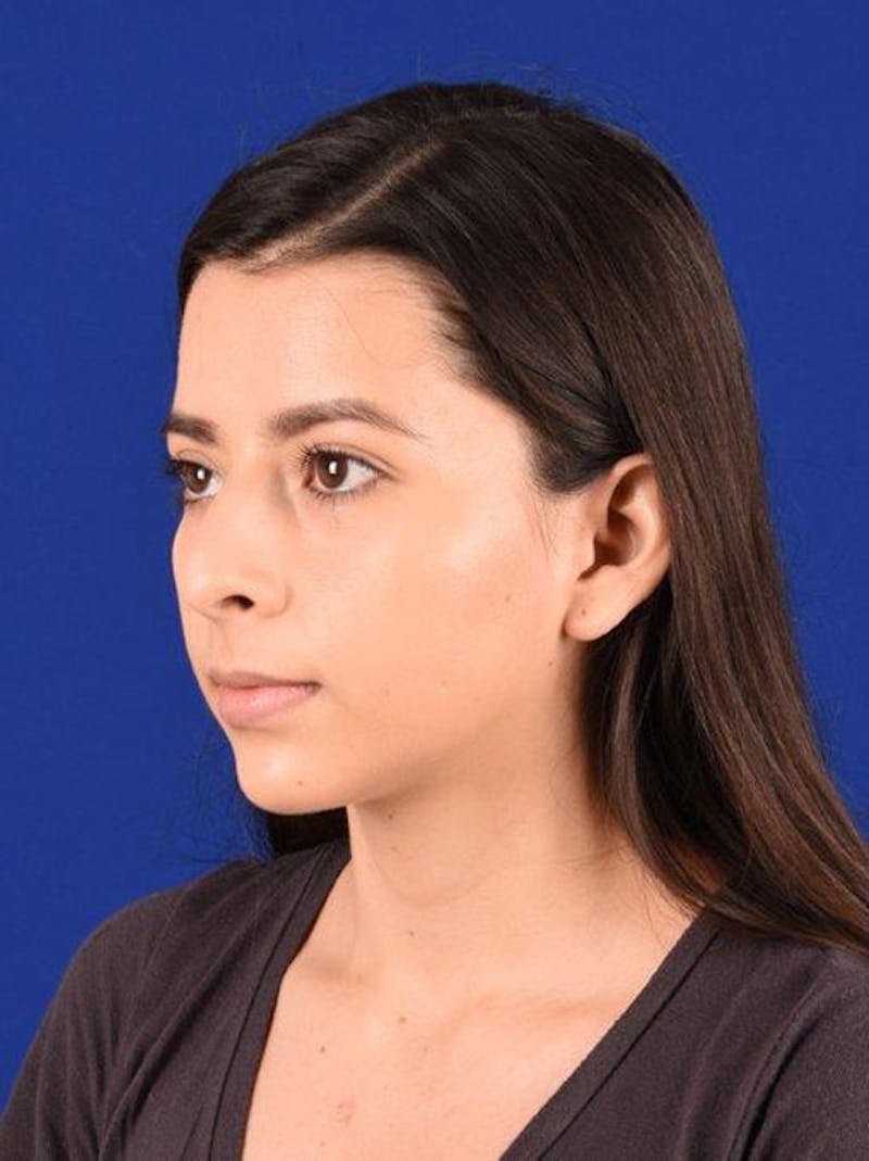 Female Rhinoplasty Before & After Gallery - Patient 17363746 - Image 3