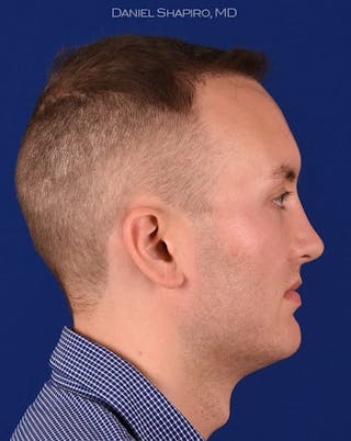Rhinoplasty Before & After Gallery - Patient 18264951 - Image 6