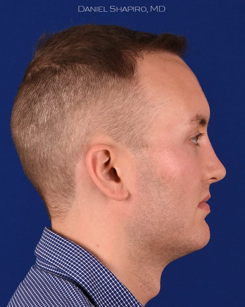 Male Rhinoplasty Before & After Gallery - Patient 17363745 - Image 6
