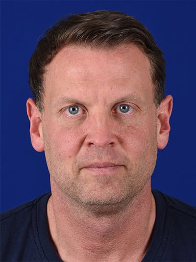 Rhinoplasty Before & After Gallery - Patient 18264952 - Image 1