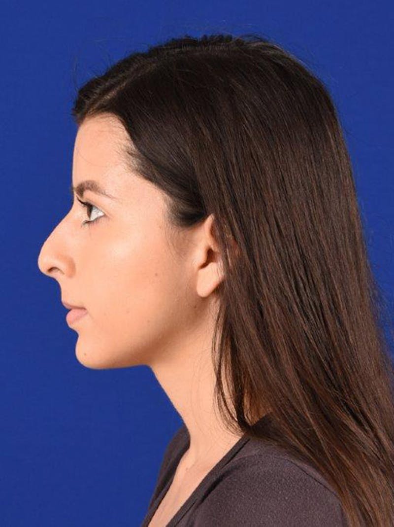 Female Rhinoplasty Before & After Gallery - Patient 17363746 - Image 5