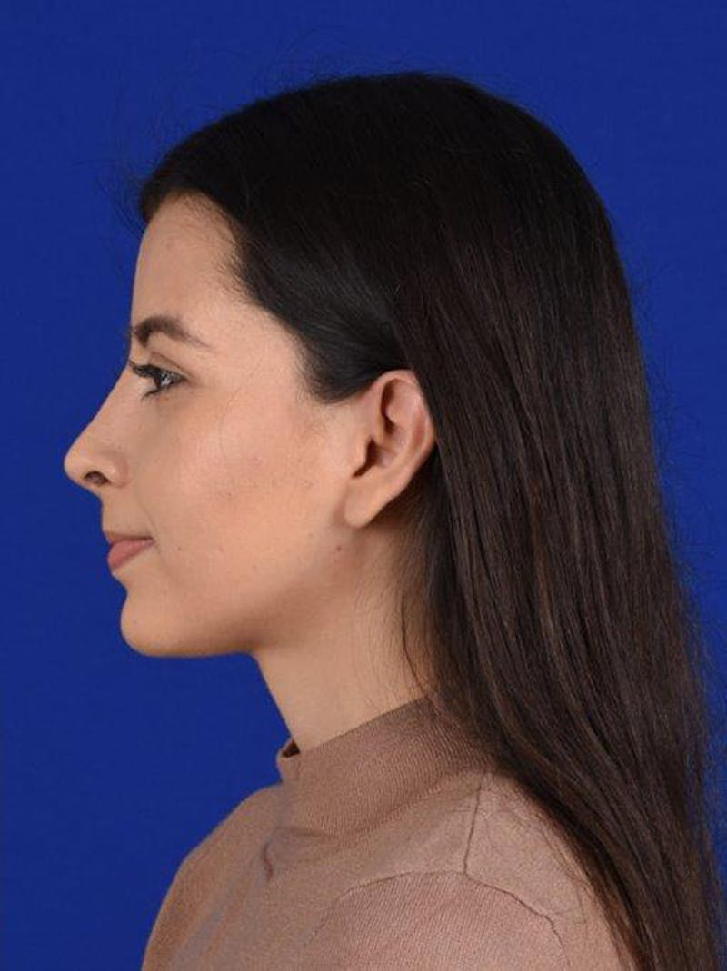 Female Rhinoplasty Before & After Gallery - Patient 17363746 - Image 6