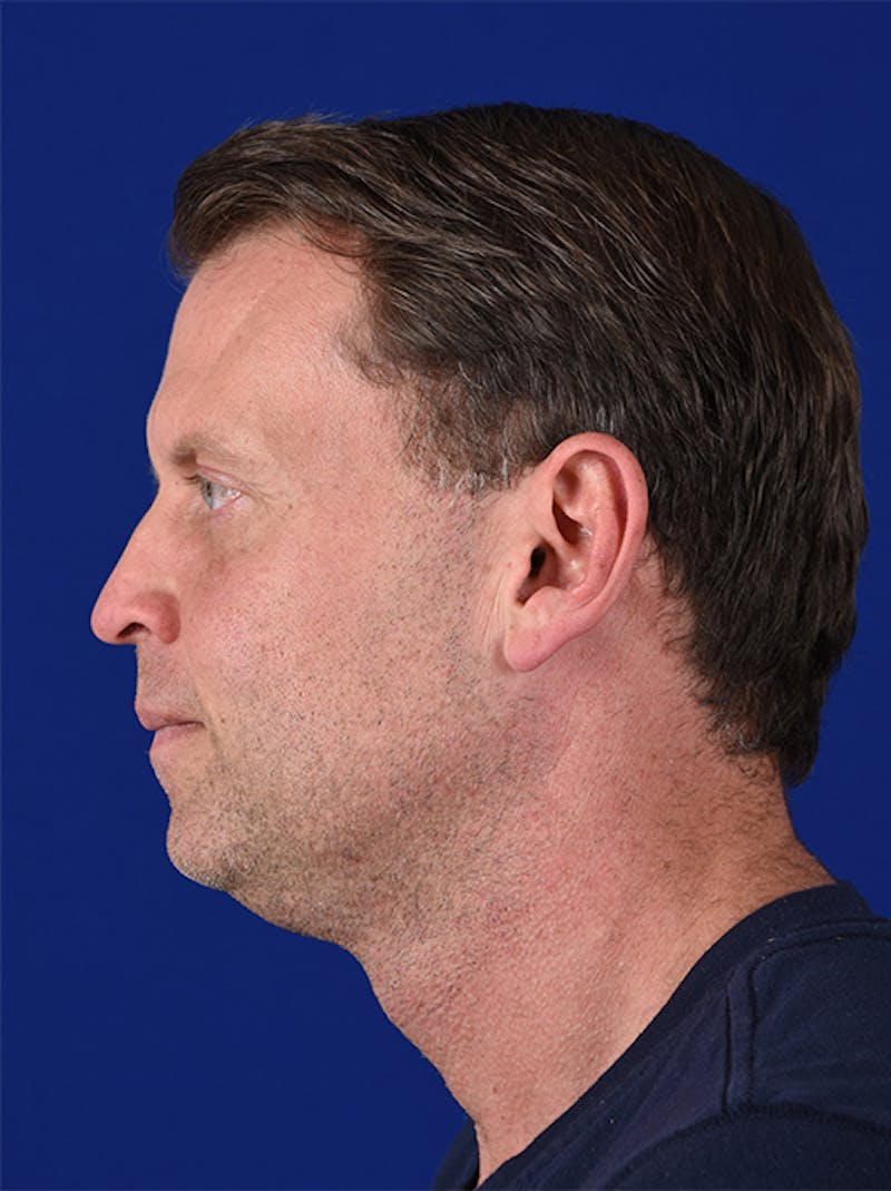 Rhinoplasty Before & After Gallery - Patient 18264952 - Image 5