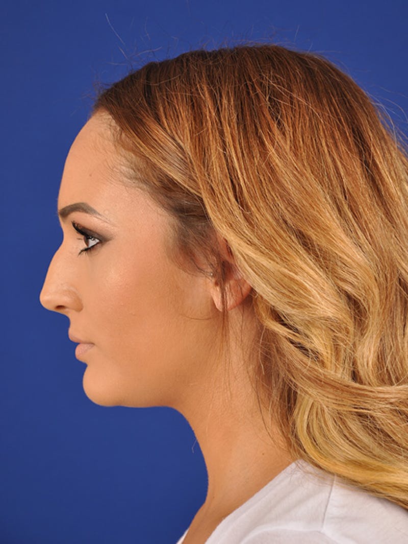 Female Rhinoplasty Before & After Gallery - Patient 17363749 - Image 5