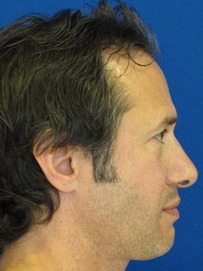 Male Rhinoplasty Before & After Gallery - Patient 17363751 - Image 3