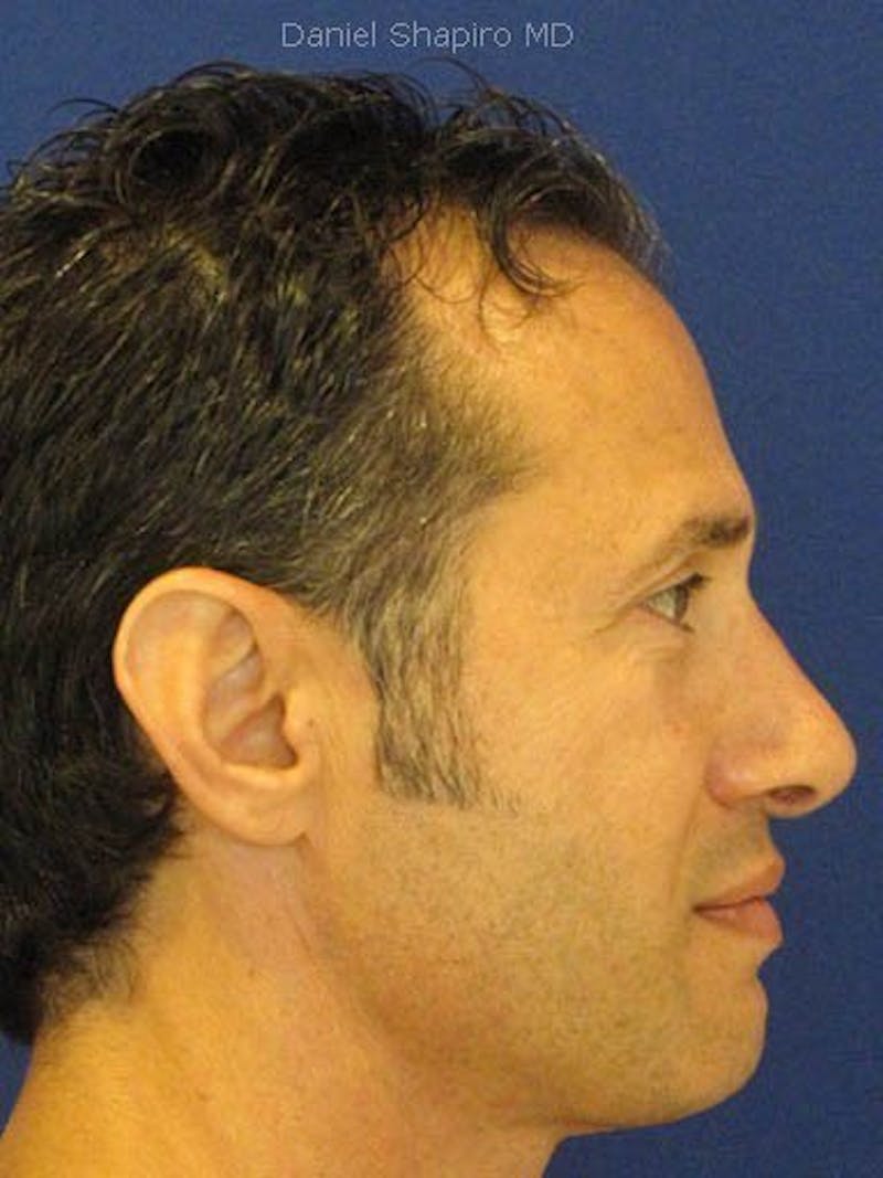 Male Rhinoplasty Before & After Gallery - Patient 17363751 - Image 4