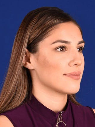 Female Rhinoplasty Before & After Gallery - Patient 17363754 - Image 4