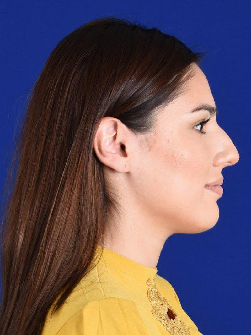 Female Rhinoplasty Before & After Gallery - Patient 17363754 - Image 5