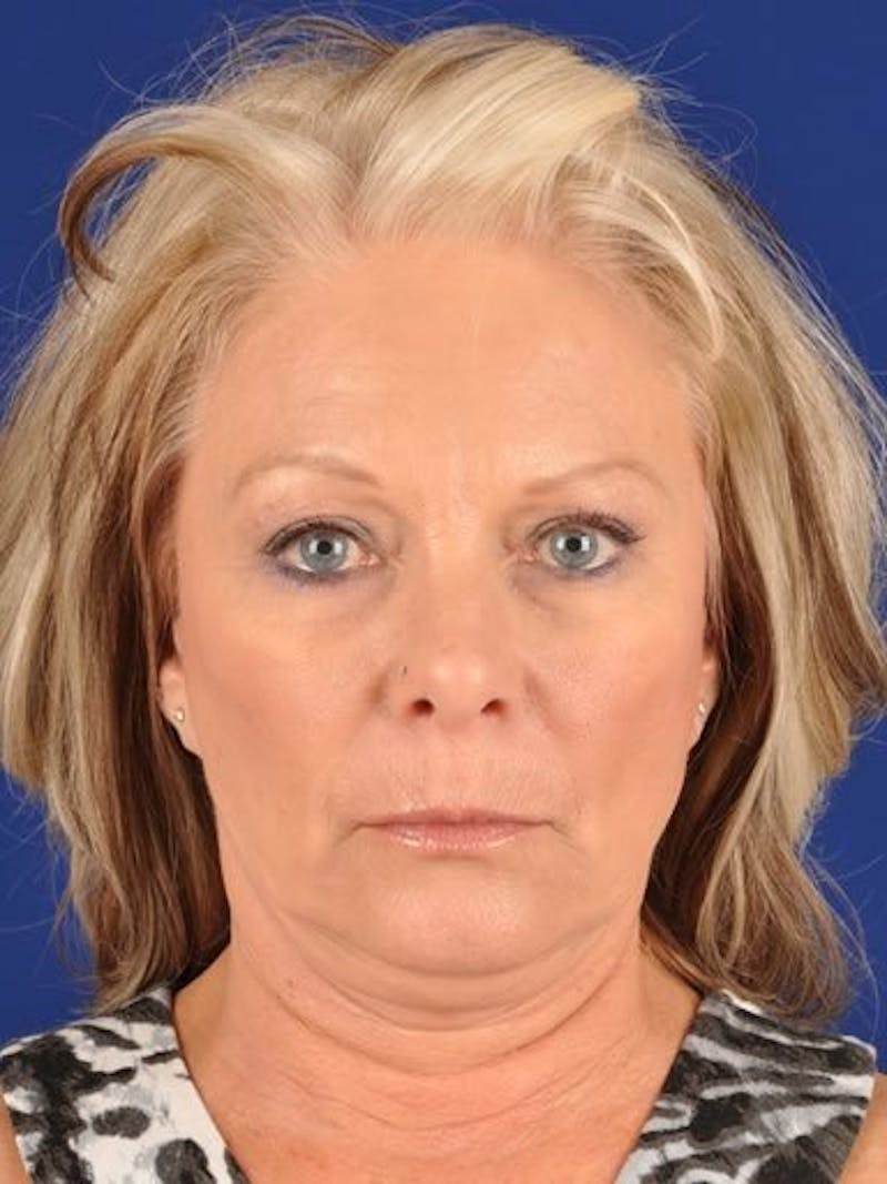Fat Transfer Face Before & After Gallery - Patient 17363755 - Image 1