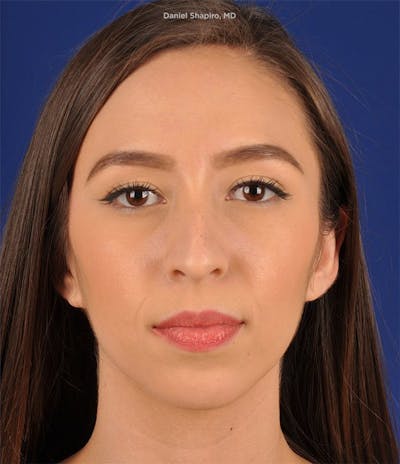Female Rhinoplasty Before & After Gallery - Patient 17363758 - Image 1