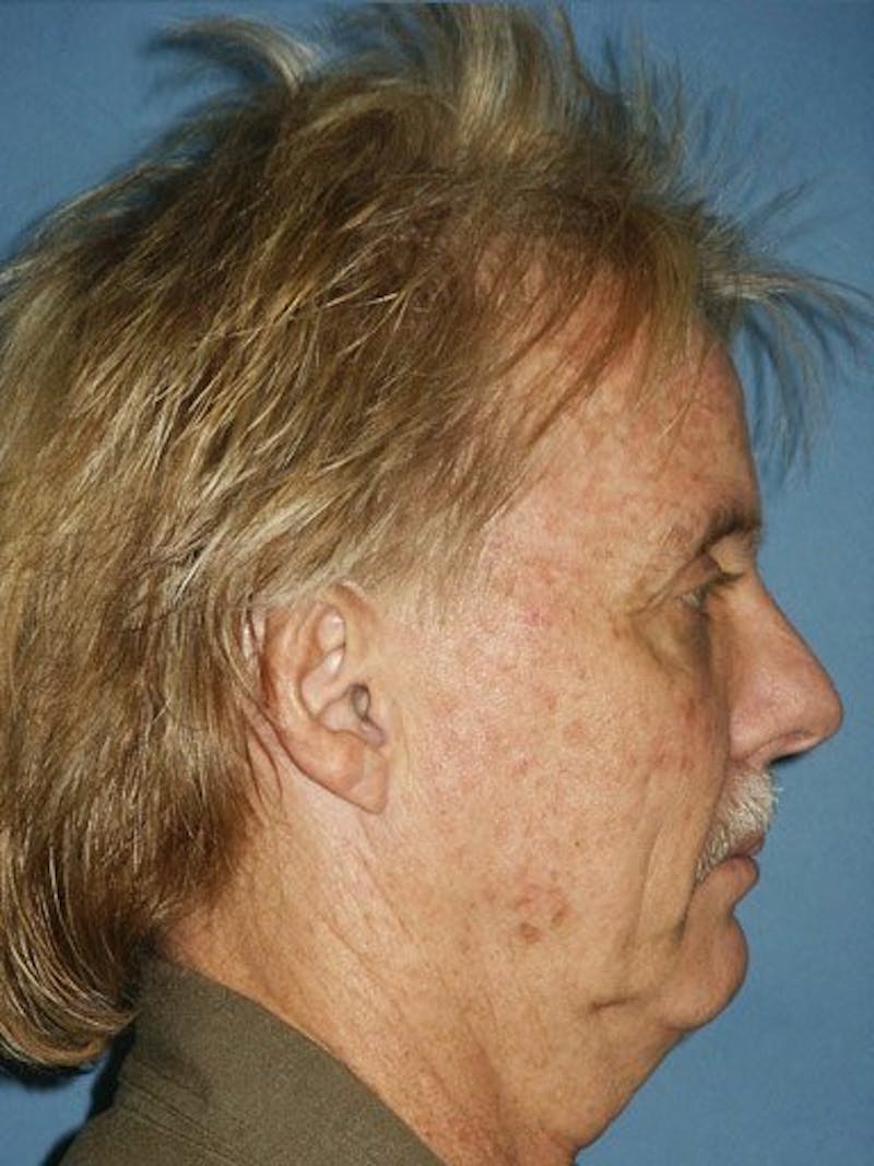 Rhinoplasty Before & After Gallery - Patient 18264955 - Image 3