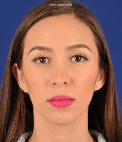 Female Rhinoplasty Before & After Gallery - Patient 17363758 - Image 2