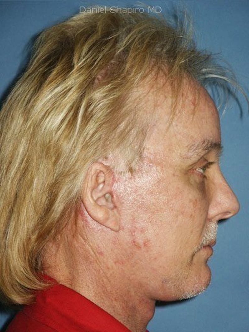 Male Rhinoplasty Before & After Gallery - Patient 17363756 - Image 4