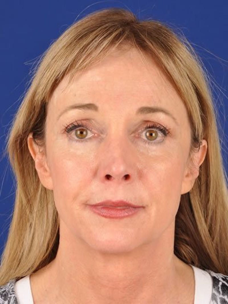 Fat Transfer Face Before & After Gallery - Patient 17363757 - Image 1
