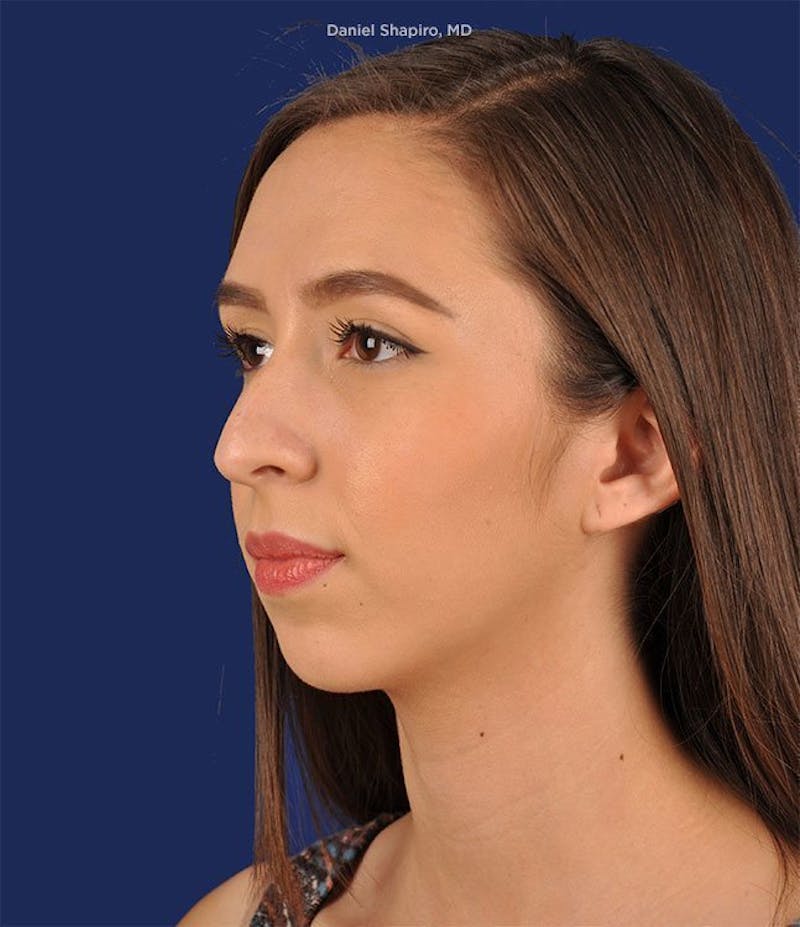 Female Rhinoplasty Before & After Gallery - Patient 17363758 - Image 3