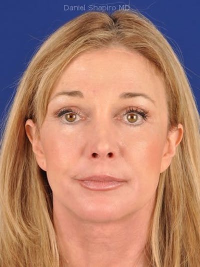 Fat Transfer Face Before & After Gallery - Patient 17363757 - Image 2
