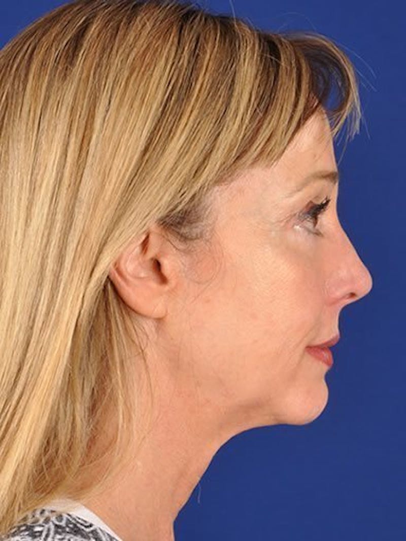 Fat Transfer Face Before & After Gallery - Patient 17363757 - Image 3