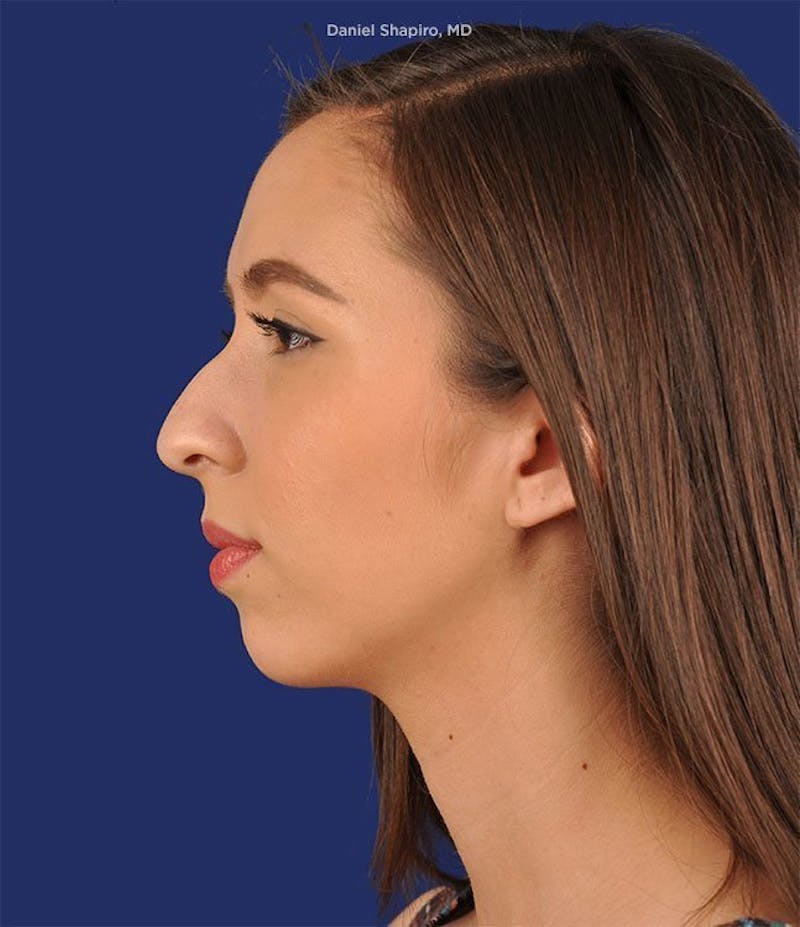 Female Rhinoplasty Before & After Gallery - Patient 17363758 - Image 5