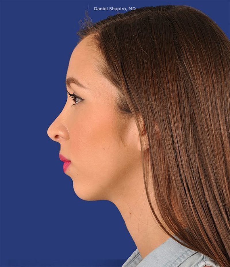 Female Rhinoplasty Before & After Gallery - Patient 17363758 - Image 6
