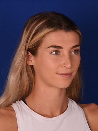 Female Rhinoplasty Before & After Gallery - Patient 17363760 - Image 4